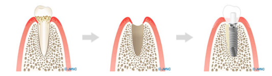 1日で歯が使えるインプラント術式「抜歯即時荷重」